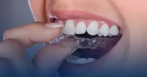 Clear aligner being placed over the teeth