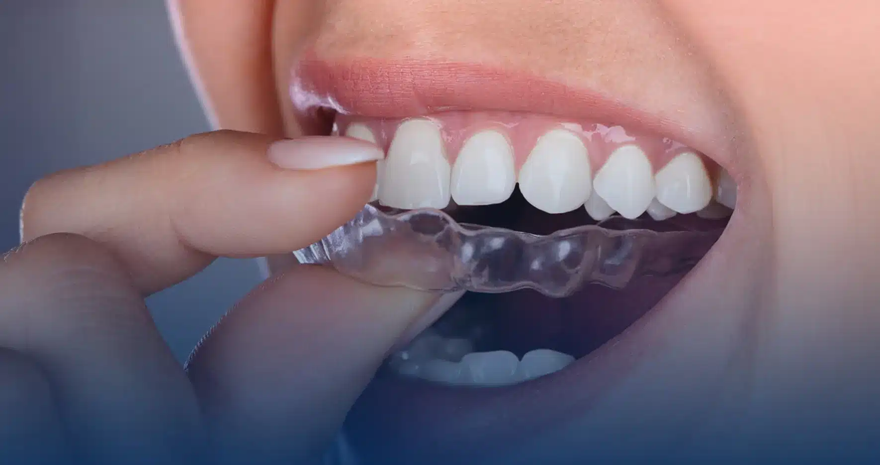 Clear aligner being placed over the teeth