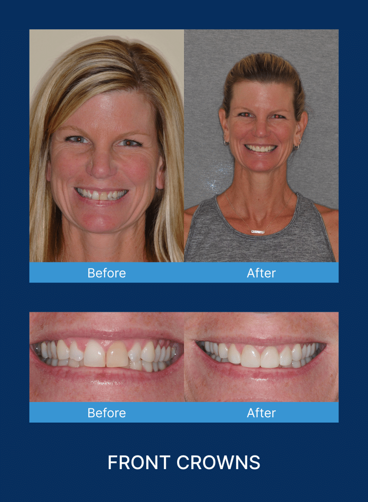 Before and after photos of front crowns