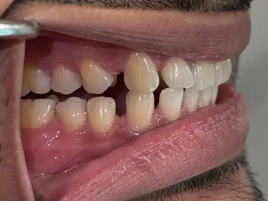 Before Invisalign: gaps and misaligned side teeth