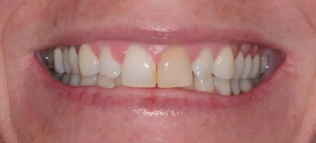 Before anterior crowns: dark front tooth