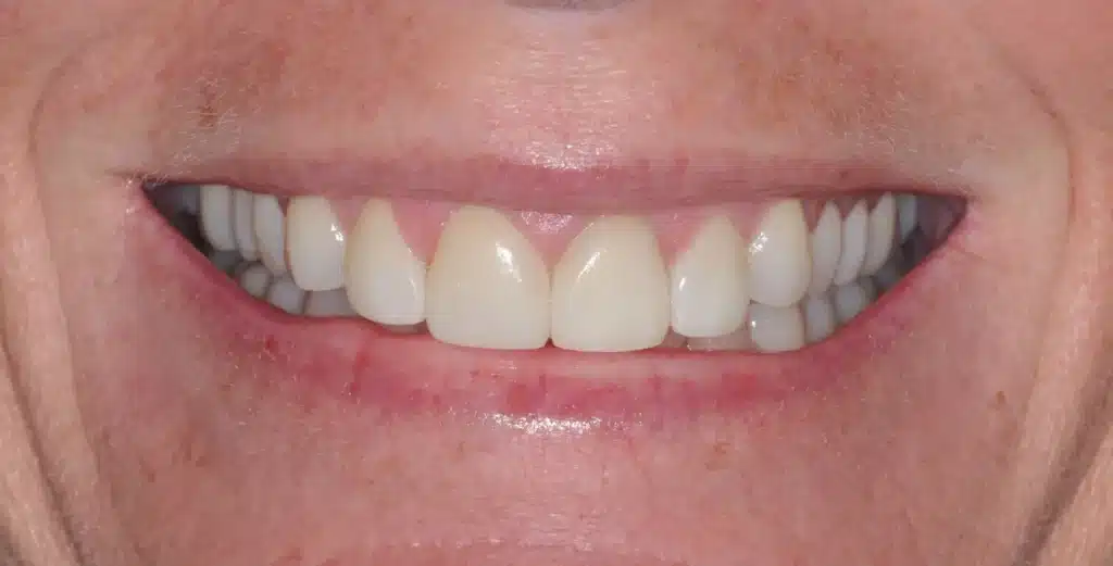 After anterior crowns: matched front teeth