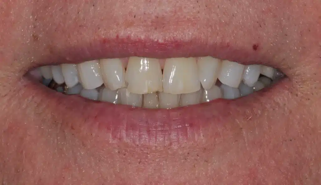 After anterior bonding: restored smile