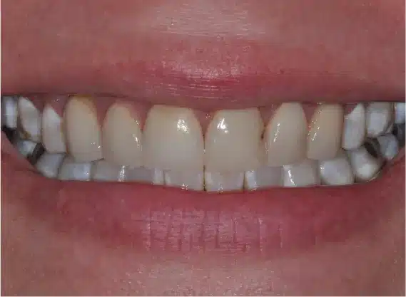 Before veneers: worn, uneven front teeth