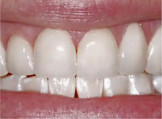 After veneers: bright, even front teeth