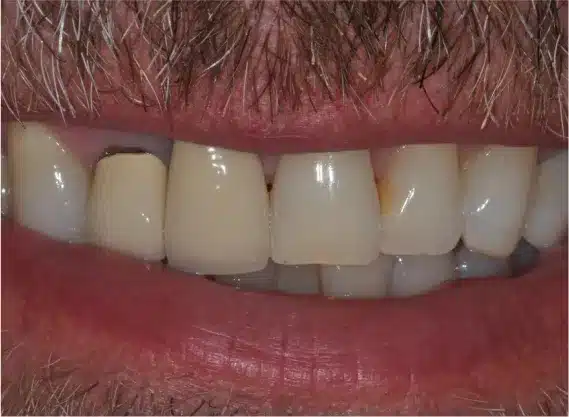 Before anterior crowns: discolored, damaged front teeth