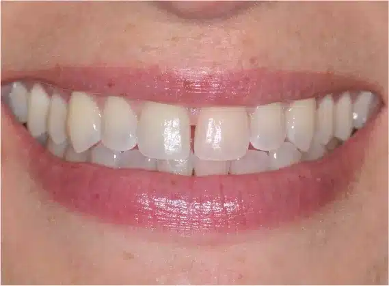 Before anterior bonding: gap between front teeth