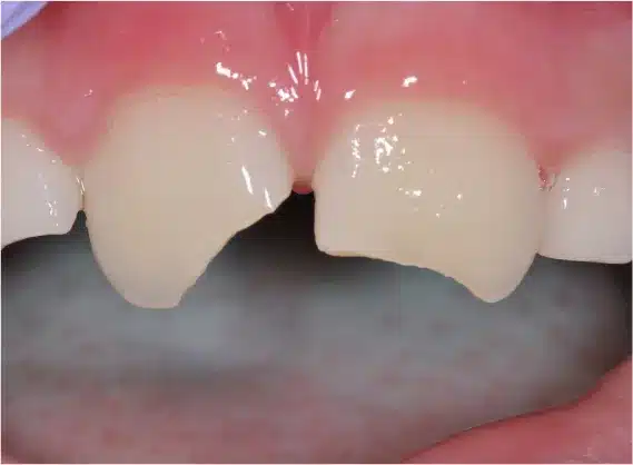 Before anterior bonding: chipped front teeth