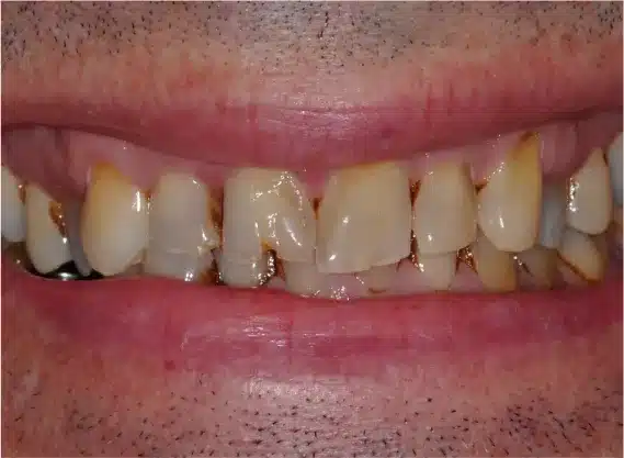 Before anterior bonding: worn, chipped teeth