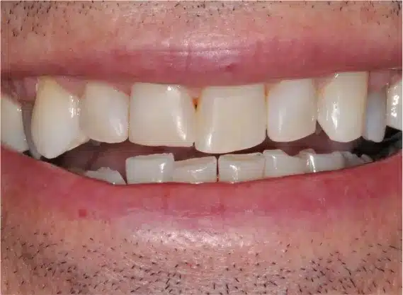 After anterior bonding: restored front teeth