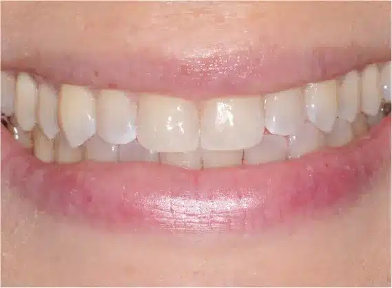 After anterior bonding: gap closed