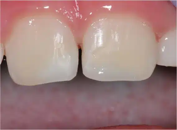 After anterior bonding: repaired front teeth