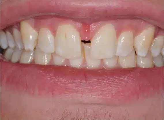 Before anterior bonding: small gap and worn edges