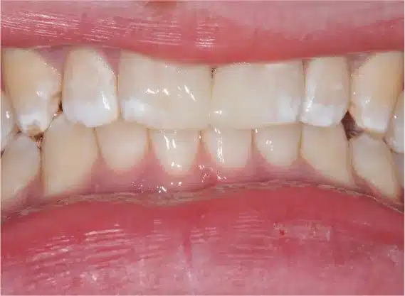 After anterior bonding: even front teeth