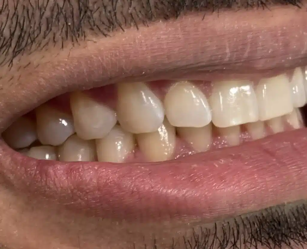 After Invisalign: aligned side teeth