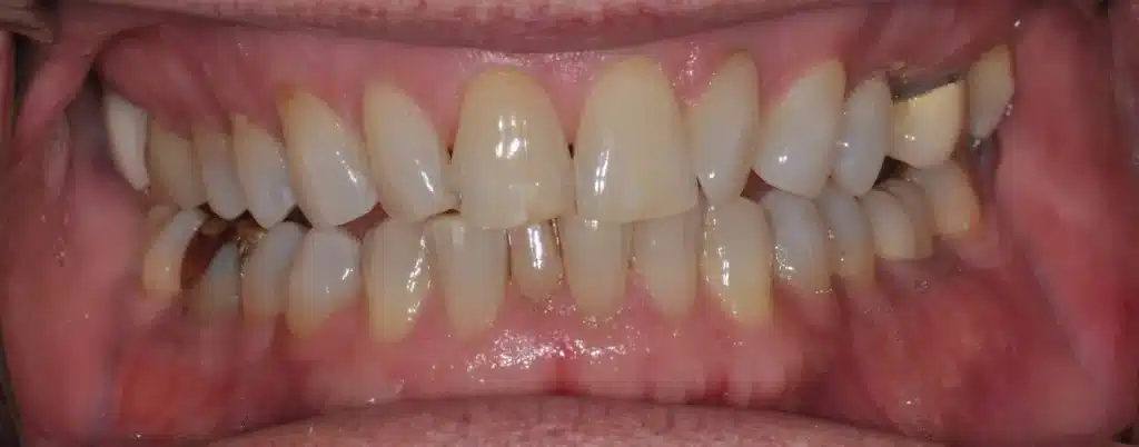 After anterior bonding: evened front teeth