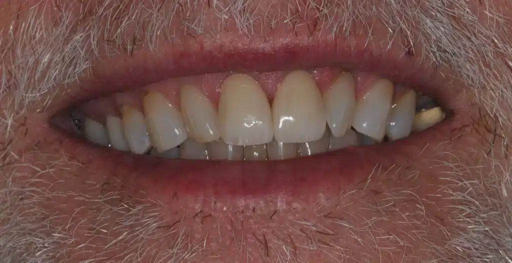 After anterior bonding: restored front teeth