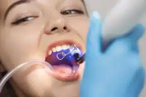 Dentist curing composite bonding on a patient's teeth