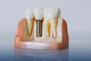 Dental implant model beside natural teeth