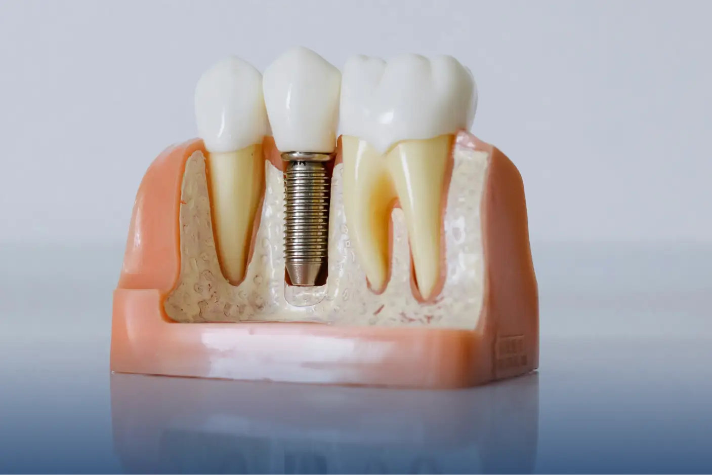 Dental implant model beside natural teeth