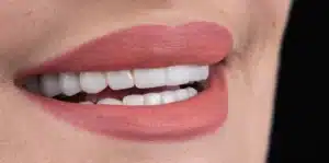 Close-up of a smile with porcelain veneers