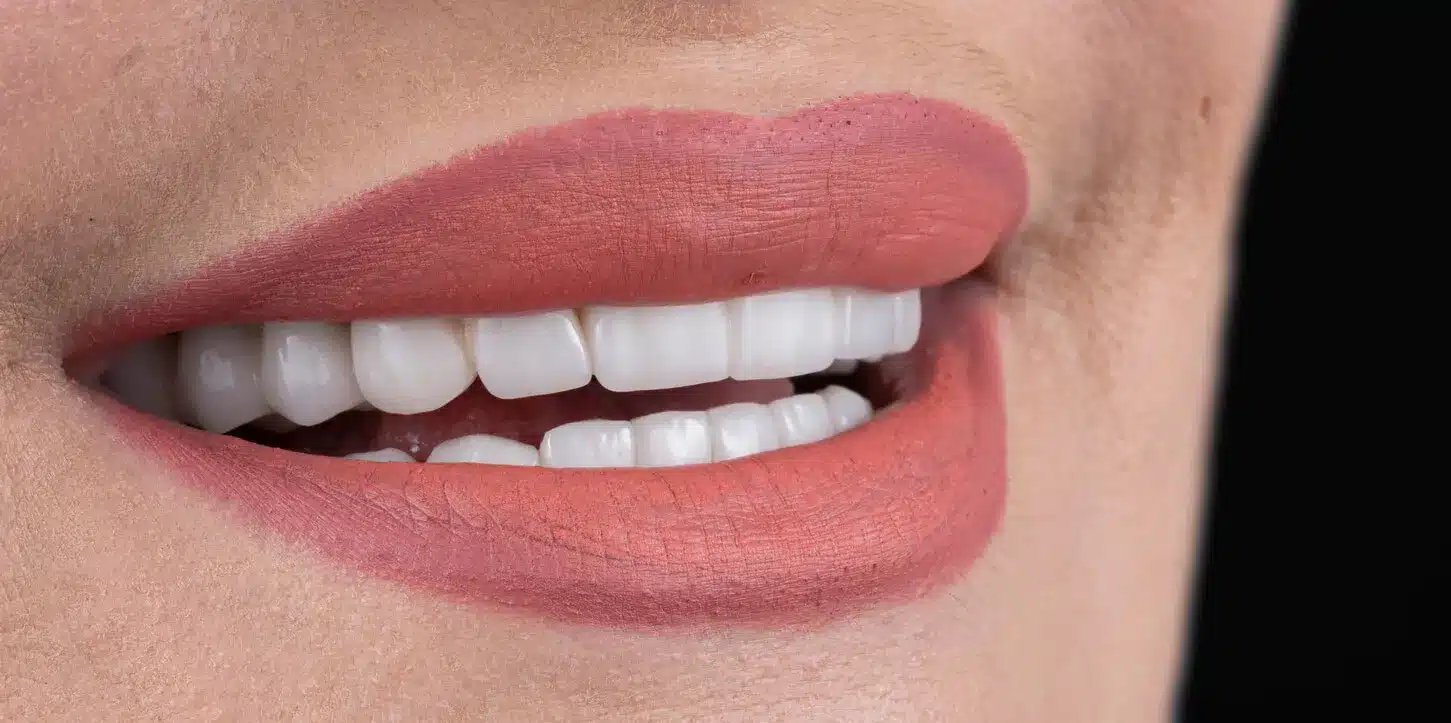 Close-up of a smile with porcelain veneers