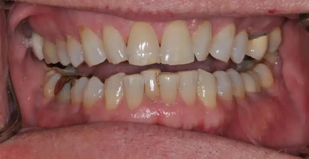 Before anterior bonding: uneven, worn teeth