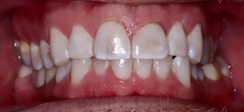 Before anterior crowns: discolored front teeth
