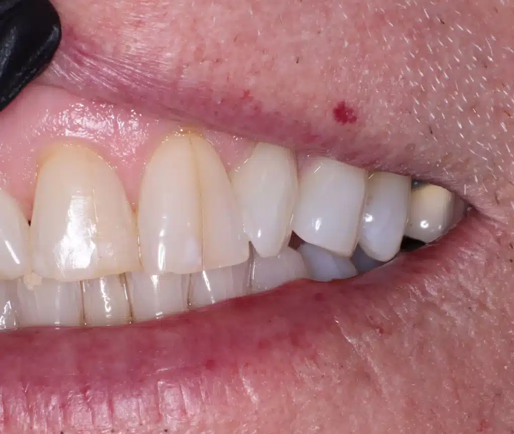 Before anterior bonding: chipped front teeth