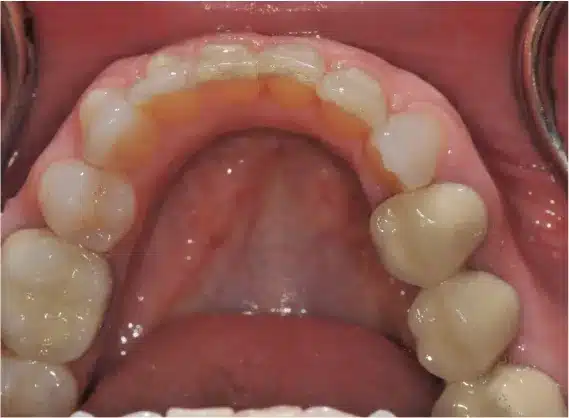 After Invisalign: aligned upper arch