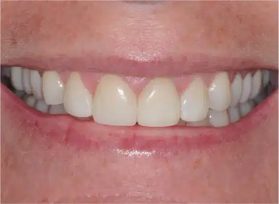 After veneers: matched, even front teeth