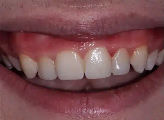 After esthetic contouring: smooth, even smile