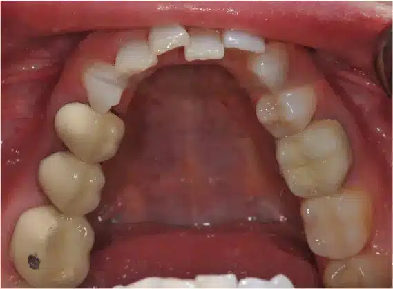 Before Invisalign: crowded upper arch