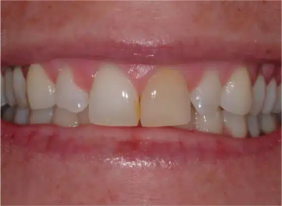 Before veneers: discolored front tooth