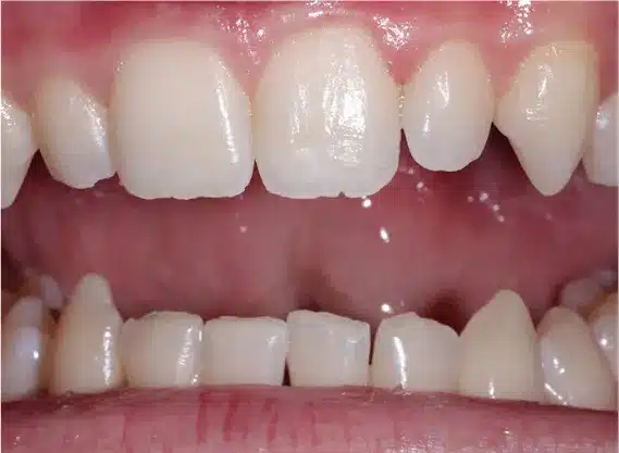 Before esthetic contouring: uneven front teeth