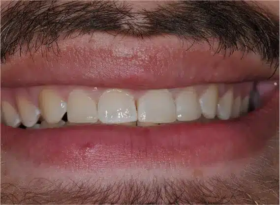 After bonding: gap closed