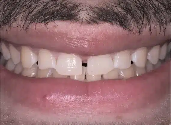 Before bonding: gap between front teeth