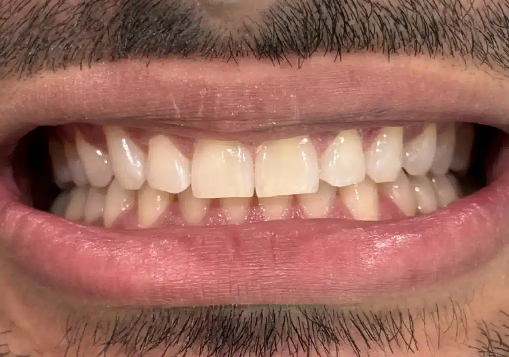 After Invisalign: closed gaps and aligned teeth