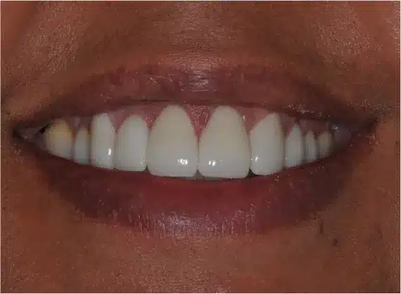 After anterior crowns: even, natural-looking smile