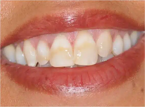 Before anterior crowns: uneven front teeth