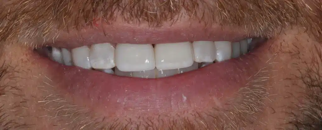 After anterior crowns: bright, even smile