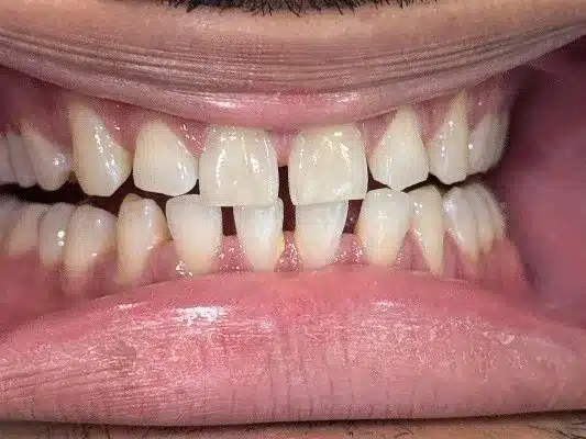 Before Invisalign: gapped front teeth