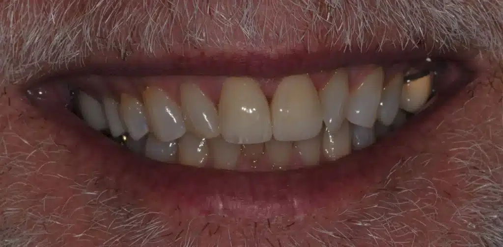 Before anterior bonding: worn front teeth