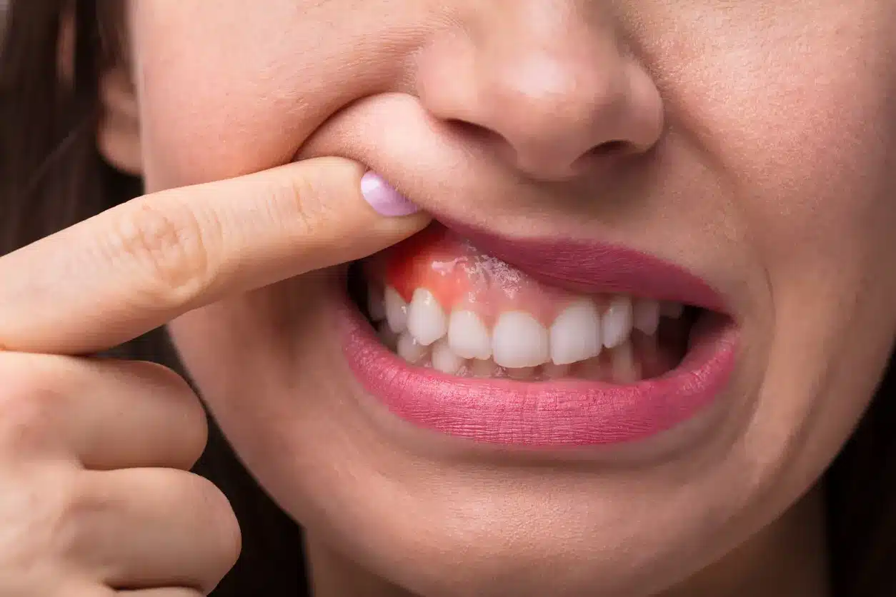 Woman pulling back her lip to show irritated gums