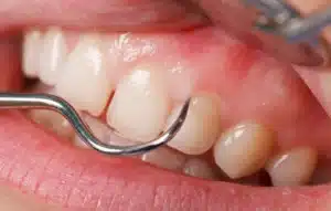 Close-up of a dental probe at the gum line